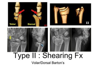 Type II : Shearing Fx
Volar/Dorsal Barton’s
 