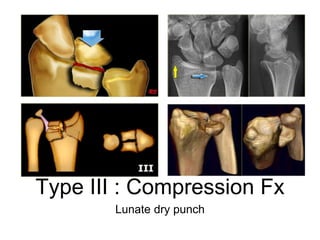 Type III : Compression Fx
Lunate dry punch
 