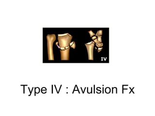 Type IV : Avulsion Fx
 