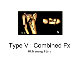 Type V : Combined Fx
High energy injury
 