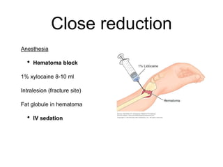 Close reduction
Anesthesia
• Hematoma block
1% xylocaine 8-10 ml
Intralesion (fracture site)
Fat globule in hematoma
• IV sedation
 