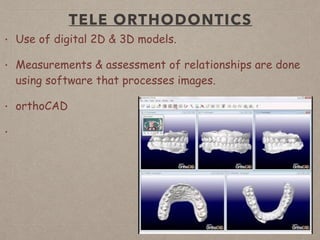 TELE ORTHODONTICS
• Use of digital 2D & 3D models.
• Measurements & assessment of relationships are done
using software that processes images.
• orthoCAD
•
 
