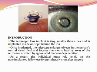 Telescopic eye implant in optometry profession | PPT