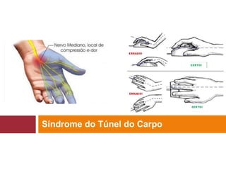 Síndrome do Túnel do Carpo
 