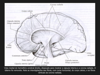 Vista medial do hemisfério cerebral direito, dissecado para mostrar a cápsula interna e a corona radiada. O
tálamo foi removido. Note as interdigitações das fibras, com curso horizontal, do corpo caloso, e as fibras
verticais da corona radiada.
 
