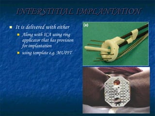 INTERSTITIAL IMPLANTATION It is delivered with either   Along with ICA using ring applicator that has provision for implantation using template e.g. MUPIT 