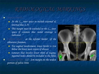 RADIOLOGICAL MARKINGS Superior border – At the L 4-5  inter space to include external & internal iliac L.N.  This margin must be extended to the L 3-4  inter space if common iliac nodal coverage is indicated. Inferior border -  at the inferior border  of the obturator foramen. For vaginal involvement, lower border is 2cm below the lower most extent of disease tumours that involve lower third of vagina, inguinal nodes should be included in the fields Lateral borders -  1.5 - 2cm margin on the widest portion of pelvic brim  