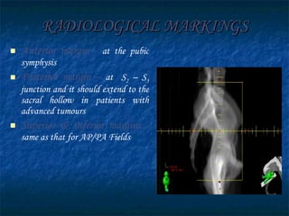 RADIOLOGICAL MARKINGS Anterior margin -   at the pubic symphysis Posterior margin –   at  S 2  – S 3  junction and it should extend to the sacral hollow in patients with advanced tumours  Superior & inferior margins -   same as that for AP/PA Fields 