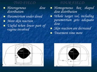 TWO FIELD Heterogenous dose distribution Parametrium under dosed More skin reaction Useful when lower part of vagina involved FOUR FIELD Homogeneous box shaped dose distribution Whole target vol. including parametrium gets adequate dose Skin reaction are decreased Treatment time more 