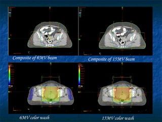 Composite of 6MV beam 6MV color wash Composite of 15MV beam 15MV color wash 