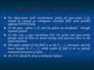 PARAAROTIC L.N. IRRADIATION For Para-aortic node involvement, pelvis & para-arotic L.N. should be treated as contiguous extended field with parallel opposed AP/PA fields. Or the para - aortic L.N. and the pelvis are irradiated  through separate portals   In this case, a gap calculation b/w the pelvic and para-aortic portals must be done to avoid overlap and excessive dose to the small intestines.  The upper margin of the field is at the T 12  - L 1  interspace and the lower margin at L 4  – L 5   while width of field is set to include transverse processes of spine. An IVU should be done to delineate kidneys 