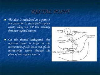 RECTAL POINT The dose is calculated at a point 5 mm posterior to (opacified) vaginal cavity along an AP line midway between vaginal sources. On the frontal radiograph, this reference point is taken at the intersection of (the lower end of) the intrauterine source through the plane of the vaginal sources. 