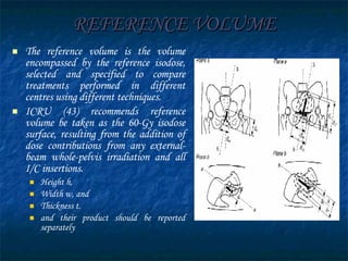 REFERENCE VOLUME The reference volume is the volume encompassed by the reference isodose, selected and specified to compare treatments performed in different centres using different techniques. ICRU (43) recommends  reference volume be taken as the 60-Gy isodose surface, resulting from the addition of dose contributions from any external-beam whole-pelvis irradiation and all I/C insertions.   Height h,  Width w, and Thickness t.  and  their product  should be reported separately 