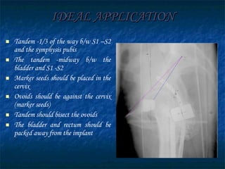 IDEAL APPLICATION Tandem -1/3 of the way b/w S1 –S2 and the symphysis pubis The tandem -midway b/w the bladder and S1 -S2 Marker seeds should be placed in the cervix Ovoids should be against the cervix (marker seeds) Tandem should bisect the ovoids The bladder and rectum should be packed away from the implant 