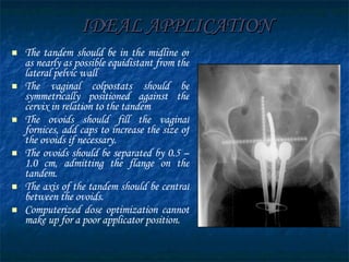 IDEAL APPLICATION The tandem should be in the midline or as nearly as possible equidistant from the lateral pelvic wall The vaginal colpostats should be symmetrically positioned against the cervix in relation to the tandem The ovoids should fill the vaginal fornices, add caps to increase the size of the ovoids if necessary. The ovoids should be separated by 0.5 –1.0 cm, admitting the flange on the tandem. The axis of the tandem should be central between the ovoids. Computerized dose optimization cannot make up for a poor applicator position.   