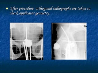 After procedure  orthogonal radiographs are taken to check applicator geometry. 