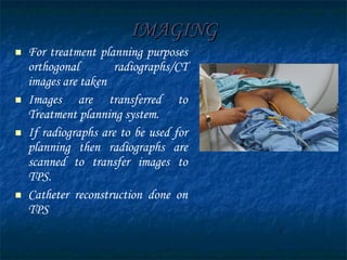 IMAGING For treatment planning purposes orthogonal radiographs/CT images are taken Images are transferred to Treatment planning system. If radiographs are to be used for planning then radiographs are scanned to transfer images to TPS. Catheter reconstruction done on TPS 