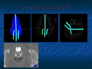 DOSE EVALUATION 