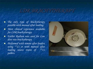 LDR BRACHYTHERAPY The only type of brachytherapy possible with manual after loading. Most clinical experience available for LDR brachytherapy Earlier Radium was used for Low dose rate brachytherapy Performed with remote after loaders using  137 Cs or with manual after loading source trains of  137 Cs pallets. 