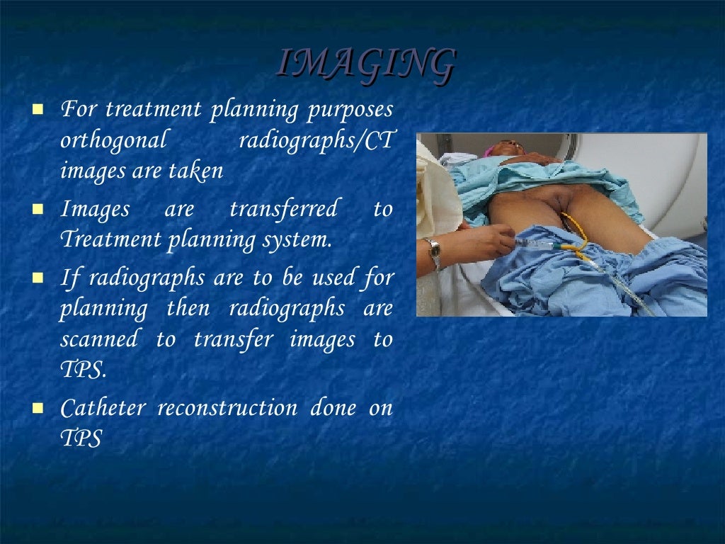 Teletherapy & Brachytherapy Techniques In Ca