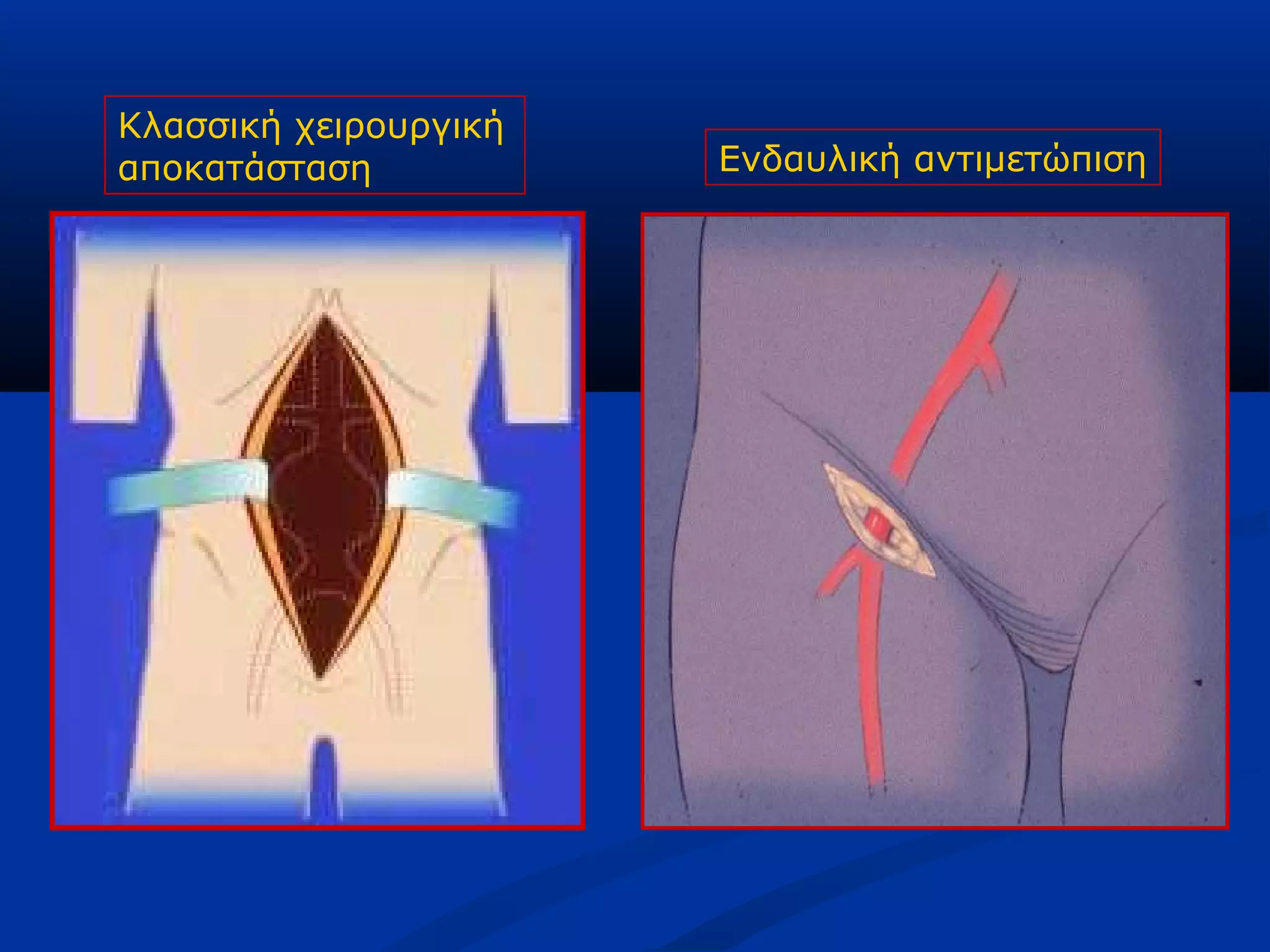 Κλασσική χειρουργική
αποκατάσταση Ενδαυλική αντιμετώπιση
 