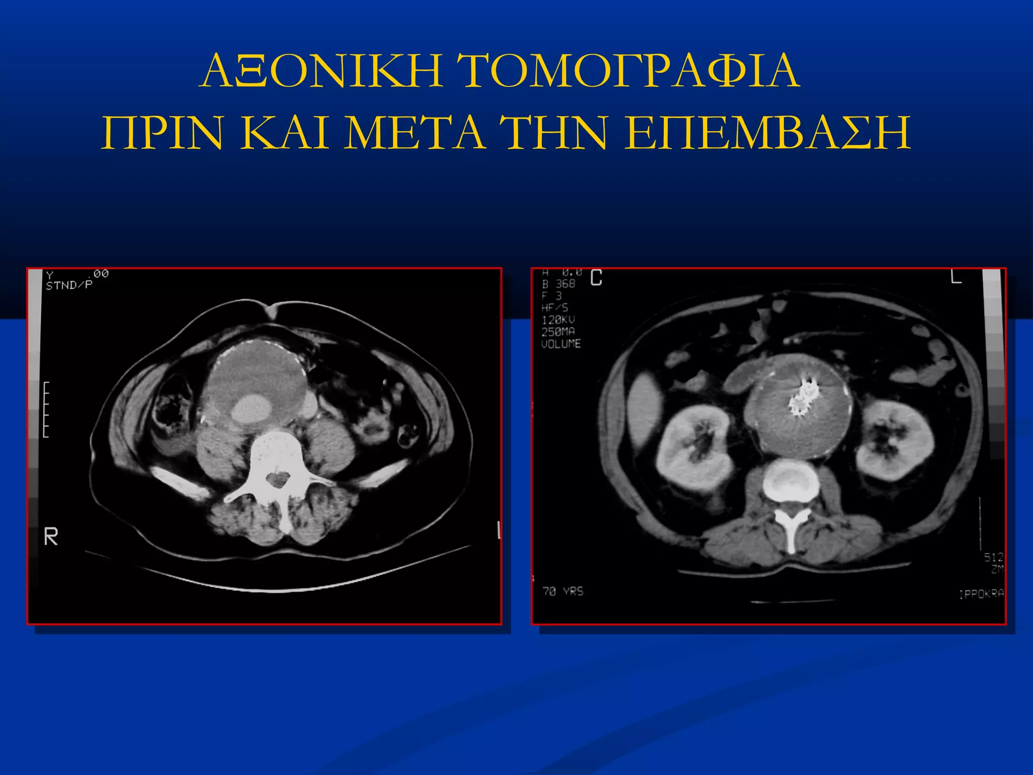 ΑΞΟΝΙΚΗ ΤΟΜΟΓΡΑΦΙΑ
ΠΡΙΝ ΚΑΙ ΜΕΤΑ ΤΗΝ ΕΠΕΜΒΑΣΗ
 