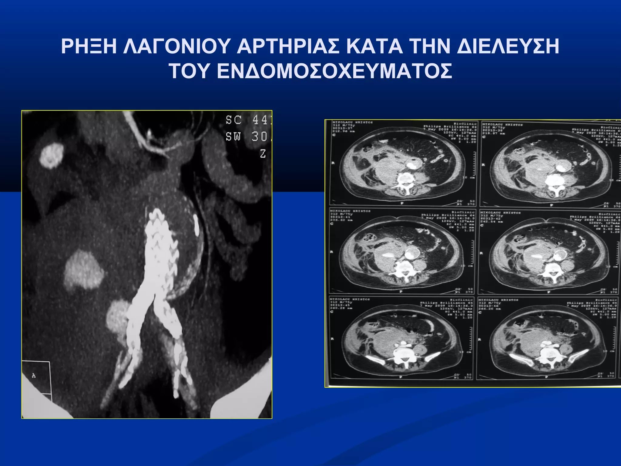 ΡΗΞΗ ΛΑΓΟΝΙΟΥ ΑΡΤΗΡΙΑΣ ΚΑΤΑ ΤΗΝ ΔΙΕΛΕΥΣΗ
ΤΟΥ ΕΝΔΟΜΟΣΟΧΕΥΜΑΤΟΣ
 