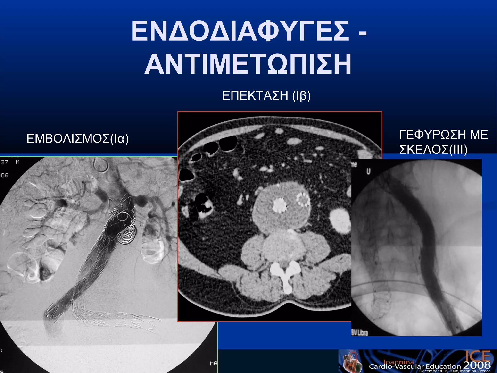 ΕΝΔΟΔΙΑΦΥΓΕΣ -
ΑΝΤΙΜΕΤΩΠΙΣΗ
ΕΜΒΟΛΙΣΜΟΣ(Ια)
ΕΠΕΚΤΑΣΗ (Ιβ)
ΓΕΦΥΡΩΣΗ ΜΕ
ΣΚΕΛΟΣ(ΙΙΙ)
 