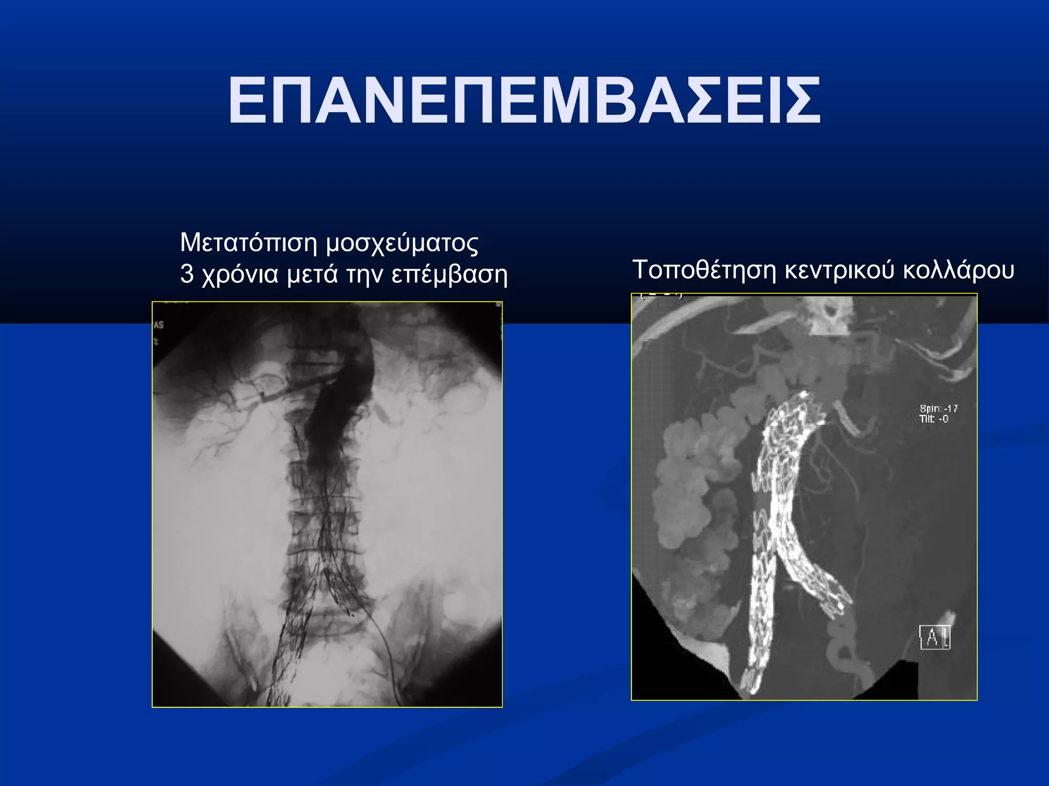 ΕΠΑΝΕΠΕΜΒΑΣΕΙΣ
Μετατόπιση μοσχεύματος
3 χρόνια μετά την επέμβαση Τοποθέτηση κεντρικού κολλάρου
 