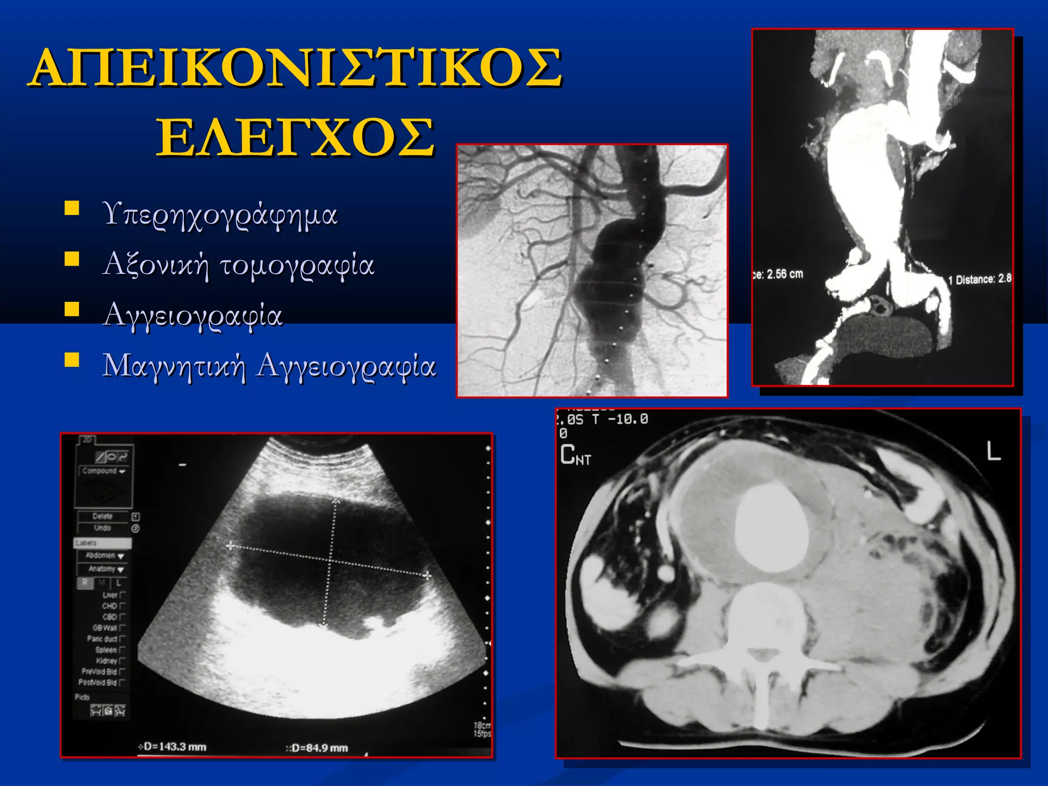 ΑΠΕΙΚΟΝΙΣΤΙΚΟΣΑΠΕΙΚΟΝΙΣΤΙΚΟΣ
ΕΛΕΓΧΟΣΕΛΕΓΧΟΣ
 ΥπερηχογράφημαΥπερηχογράφημα
 Αξονική τομογραφίαΑξονική τομογραφία
 ΑγγειογραφίαΑγγειογραφία
 Μαγνητική ΑγγειογραφίαΜαγνητική Αγγειογραφία
 
