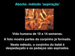 Vida humana de 10 a 14 semanas. A foto mostra partes do corpinho já formado. Neste método, o corpinho do bebê é despedaçado e os pedaços são aspirados. Aborto: método ‘aspiração’ 