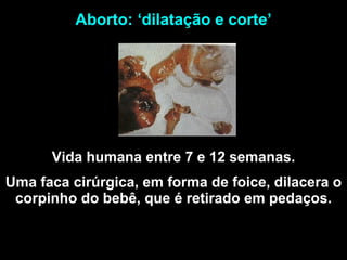Vida humana entre 7 e 12 semanas. Uma faca cirúrgica, em forma de foice, dilacera o corpinho do bebê, que é retirado em pedaços. Aborto: ‘dilatação e corte’ 