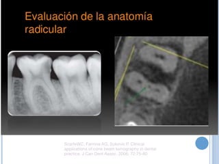ScarfeWC, Farmna AG, Sukovic P. Clinical
applications of cone beam tomography in dental
practice. J Can Dent Assoc. 2006; 72:75-80
 