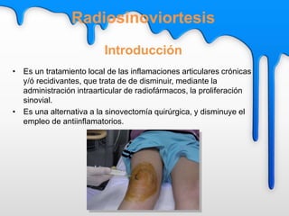 • Es un tratamiento local de las inflamaciones articulares crónicas
y/ó recidivantes, que trata de de disminuir, mediante la
administración intraarticular de radiofármacos, la proliferación
sinovial.
• Es una alternativa a la sinovectomía quirúrgica, y disminuye el
empleo de antiinflamatorios.
Radiosinoviortesis
Introducción
 