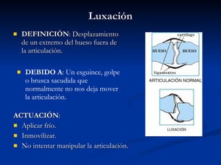 Luxación DEFINICIÓN : Desplazamiento de un extremo del hueso fuera de la articulación. ACTUACIÓN : Aplicar frío. Inmovilizar. No intentar manipular la articulación. DEBIDO A : Un esguince, golpe o brusca sacudida que normalmente no nos deja mover la articulación. 
