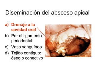 Diseminación del absceso apical
a) Drenaje a la
cavidad oral
b) Por el ligamento
periodontal
c) Vaso sanguíneo
d) Tejido contiguo:
óseo o conectivo
 
