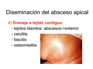 d) Drenaje a tejido contiguo
- tejidos blandos: abscesos->exterior
- celulitis
- fascitis
- osteomielitis
Diseminación del absceso apical
 