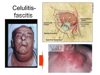 Celulitis-
fascitis
 