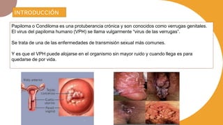 INTRODUCCIÓN
Papiloma o Condiloma es una protuberancia crónica y son conocidos como verrugas genitales.
El virus del papiloma humano (VPH) se llama vulgarmente “virus de las verrugas”.
Se trata de una de las enfermedades de transmisión sexual más comunes.
Y es que el VPH puede alojarse en el organismo sin mayor ruido y cuando llega es para
quedarse de por vida.
 