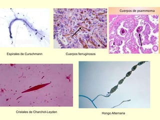 Cristales de Charchot-Leyden Hongo Alternaria
Espirales de Curschmann Cuerpos ferruginosos
 