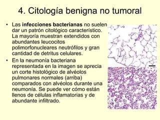 4. Citología benigna no tumoral
• Las infecciones bacterianas no suelen
dar un patrón citológico característico.
La mayoría muestran extendidos con
abundantes leucocitos
polimorfonucleares neutrófilos y gran
cantidad de detritus celulares.
• En la neumonía bacteriana
representada en la imagen se aprecia
un corte histológico de alvéolos
pulmonares normales (arriba)
comparados con alvéolos durante una
neumonía. Se puede ver cómo están
llenos de células inflamatorias y de
abundante infiltrado.
 