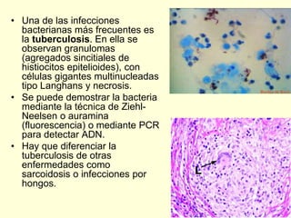 • Una de las infecciones
bacterianas más frecuentes es
la tuberculosis. En ella se
observan granulomas
(agregados sincitiales de
histiocitos epitelioides), con
células gigantes multinucleadas
tipo Langhans y necrosis.
• Se puede demostrar la bacteria
mediante la técnica de Ziehl-
Neelsen o auramina
(fluorescencia) o mediante PCR
para detectar ADN.
• Hay que diferenciar la
tuberculosis de otras
enfermedades como
sarcoidosis o infecciones por
hongos.
L
 