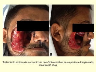 Tratamiento exitoso de mucormicosis rino-órbito-cerebral en un paciente trasplantado
renal de 33 años
 