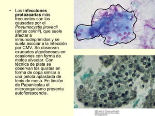 • Las infecciones
protozoarias más
frecuentes son las
causadas por el
Pneumocystis jirovecii
(antes carinii), que suele
afectar a
inmunodeprimidos y se
suela asociar a la infección
por CMV. Se observan
exudados algodonosos en
ocasiones con forma de
molde alveolar. Con
técnica de plata se
observan los quistes en
forma de copa similar a
una pelota aplastada de
tenis de mesa. En tinción
de Papanicolau el
microorganismo presenta
autoflorescencia.
 