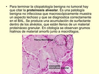 • Para terminar la citopatología benigna no tumoral hay
que citar la proteinosis alveolar. Es una patología
benigna no infecciosa que macroscópicamente muestra
un aspecto lechoso y que se diagnostica correctamente
en el BAL. Se produce una acumulación de surfactante
dentro de los alvéolos, que están llenos de un material
proteináceo granular. En citología se observan grumos
hialinos de material amorfo junto a macrófagos.
 