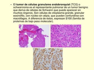 – El tumor de células granulares endobronquial (TCG) o
schwannoma es el representante pulmonar de un tumor benigno
que deriva de células de Schwann que puede aparecer en
muchos órganos. Son células de citoplasma grande, granular
eosinófilo, con núcleo sin atipia, que pueden confundirse con
macrófagos. A diferencia de éstos, expresan S100 (familia de
proteínas de bajo peso molecular).
 