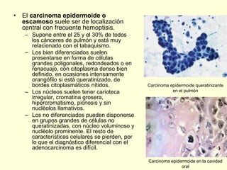 • El carcinoma epidermoide o
escamoso suele ser de localización
central con frecuente hemoptisis.
– Supone entre el 25 y el 30% de todos
los cánceres de pulmón y está muy
relacionado con el tabaquismo.
– Los bien diferenciados suelen
presentarse en forma de células
grandes poligonales, redondeados o en
renacuajo, con citoplasma denso bien
definido, en ocasiones intensamente
orangófilo si está queratinizado, de
bordes citoplasmáticos nítidos.
– Los núcleos suelen tener carioteca
irregular, cromatina grosera,
hipercromatismo, picnosis y sin
nucléolos llamativos.
– Los no diferenciados pueden disponerse
en grupos grandes de células no
queratinizadas, con núcleo voluminoso y
nucléolo prominente. El resto de
características celulares se pierden, por
lo que el diagnóstico diferencial con el
adenocarcinoma es difícil.
Carcinoma epidermoide queratinizante
en el pulmón
Carcinoma epidermoide en la cavidad
oral
 