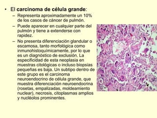 • El carcinoma de célula grande:
– Representa aproximadamente un 10%
de los casos de cáncer de pulmón.
– Puede aparecer en cualquier parte del
pulmón y tiene a extenderse con
rapidez.
– No presenta diferenciación glandular o
escamosa, tanto morfológica como
inmunohistoquímicamente, por lo que
es un diagnóstico de exclusión. La
especificidad de esta neoplasia en
muestras citológicas o incluso biopsias
pequeñas es baja. Un subtipo dentro de
este grupo es el carcinoma
neuroendocrino de célula grande, que
muestra diferenciación neuroendocrina
(rosetas, empalizadas, moldeamiento
nuclear), necrosis, citoplasmas amplios
y nucléolos prominentes.
 
