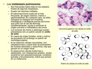 • Las metástasis pulmonares:
– Son frecuentes sobre todo en los estadios
finales de algunas neoplasias.
– Suelen ser lesiones múltiples.
– El adenocarcinoma suele ser el más
frecuente, de origen colónico, mama o
gastrointestinal. En cualquier caso, se debe
comparar la citología con muestras
histológicas o citológicas previas del tumor,
que junto con el uso de técnicas
complementarias, ayuda a confirmar el
origen primario o metastásico del tumor.
– Los tumores de mama o estómago suelen
presentarse con un patrón celular en anillo
de sello.
– En casos de origen tiroideo, renal u ovárico
se encuentra sin embargo un patrón de
morfología papilar.
– Si se observan células vacuoladas, con
citoplasma laxo y sobre todo se acompañan
de núcleos desnudos y vasos finos, hay que
pensar en un origen renal.
– Si observamos células fusiformes o
epitelioides, con citoplasmas amplios, núcleo
excéntrico con pseudoinclusiones, nucléolos
grandes y binucleaciones, habrá que pensar
en un melanoma.
Carcinoma gástrico con células en anillo
de sello
Patrón de células en anillo de sello
 