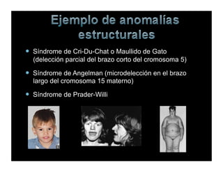 !  Síndrome de Cri-Du-Chat o Maullido de Gato
(delección parcial del brazo corto del cromosoma 5)
!  Síndrome de Angelman (microdelección en el brazo
largo del cromosoma 15 materno)
!  Síndrome de Prader-Willi
 